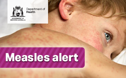Measles alert