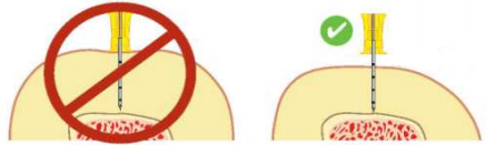 Intraosseous access - procedure for mechanised intraosseous needle insertion
