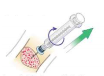 Remove of Intraousseous access