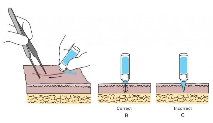 Skin glue application